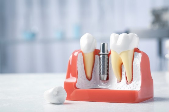 A closeup of a dental implant model